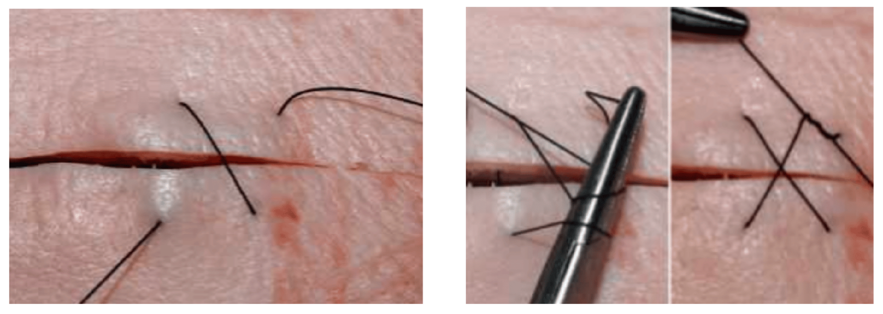 Regla práctica para recordar Absorbibles → Dentro del cuerpo (tejidos profundos). No absorbibles → Principalmente en piel o estructuras que requieren alta resistencia.